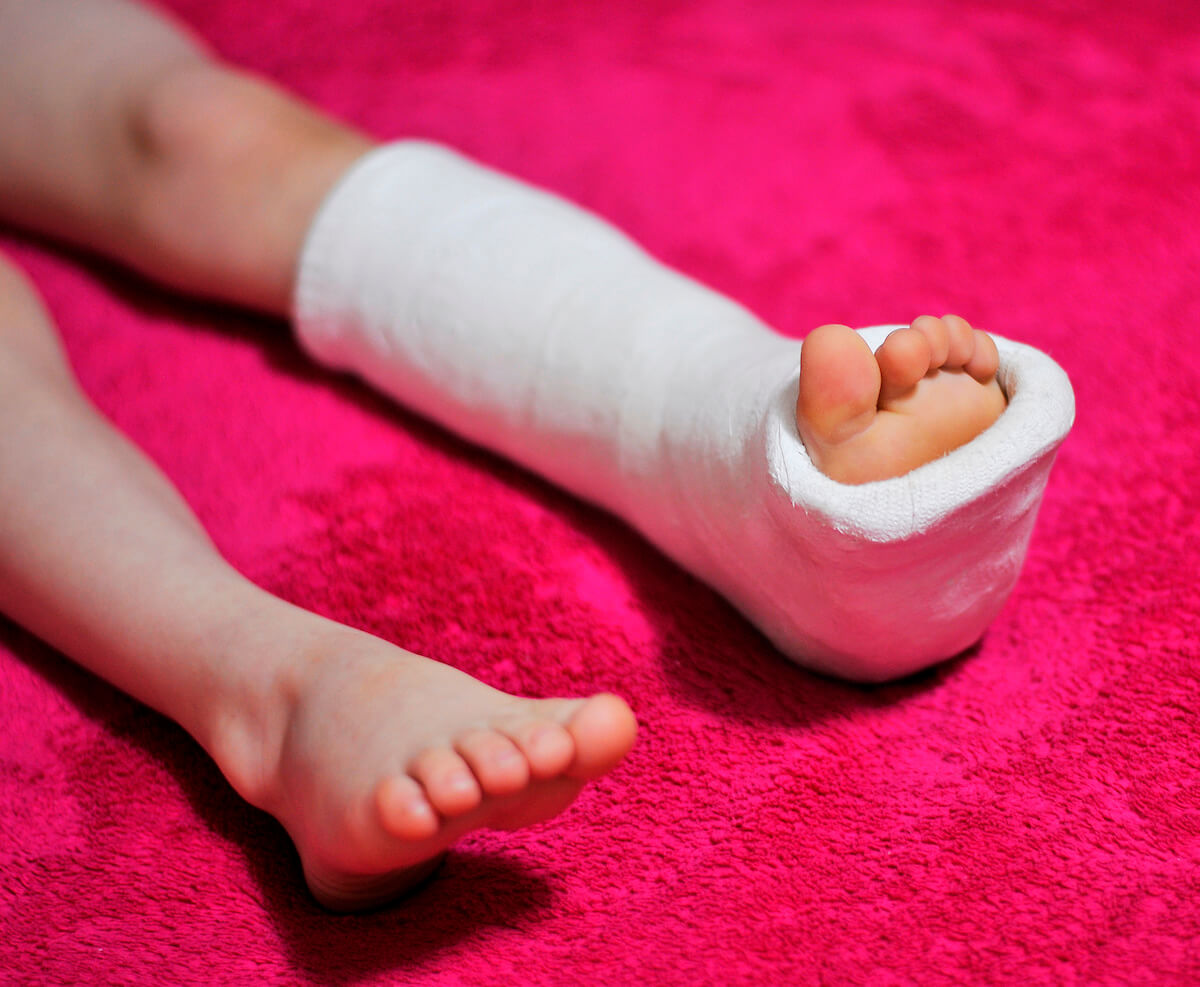 Photo of a child's leg in a cast