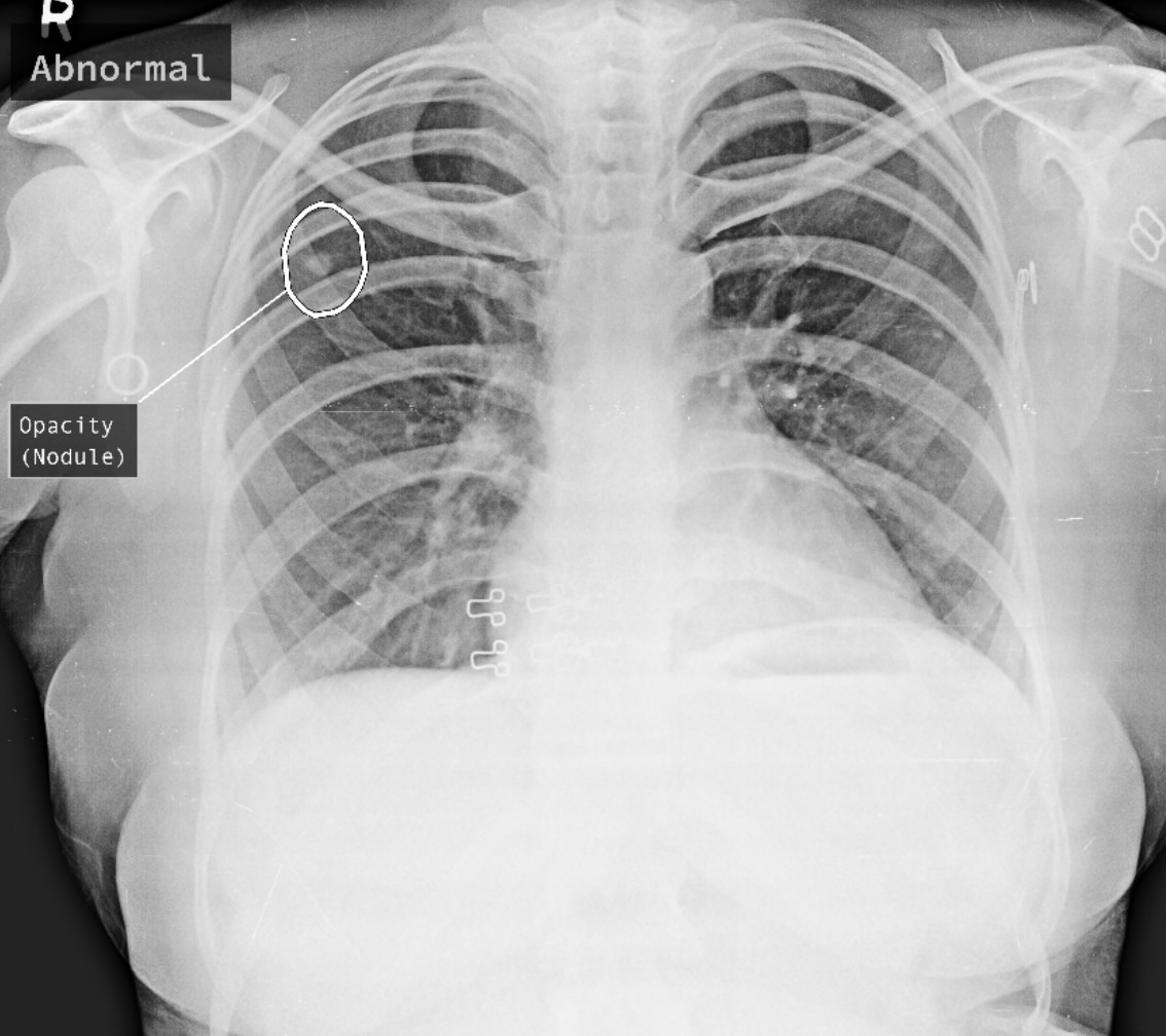 X-ray image of lungs with Tuberculosis