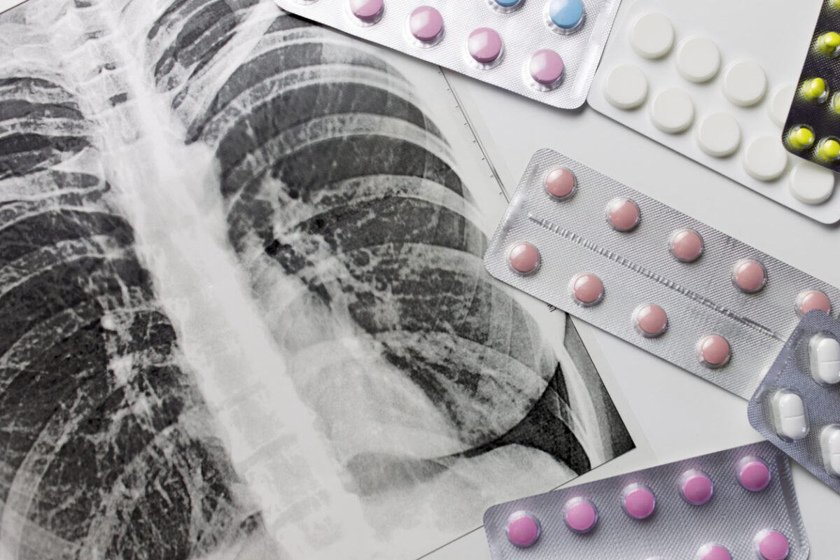 Photo of lung X-ray along with Tuberculosis drugs