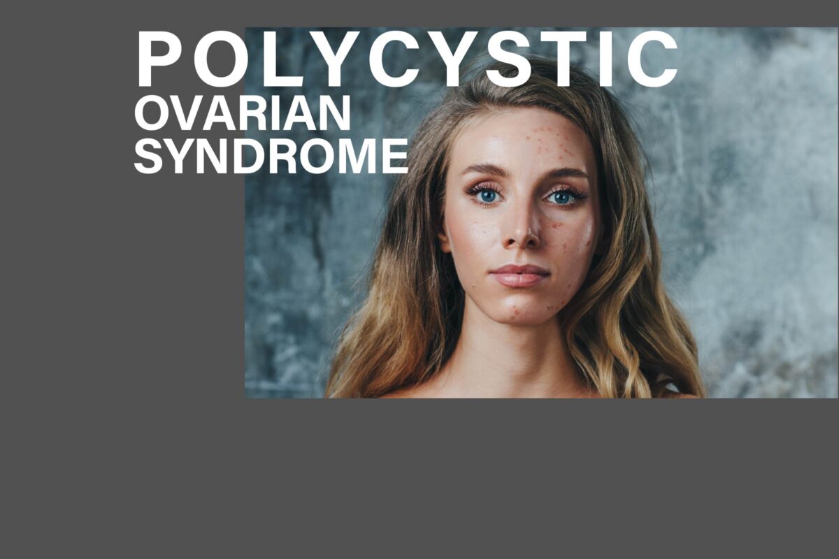 Photo of woman in child bearing years with acne denoting possible symptom of Polycystic Ovarian Syndrome, the topic for the April CME